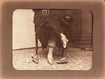 Lot 14 - China. A Chinese woman’s bound feet, by William Saunders, c. 1870