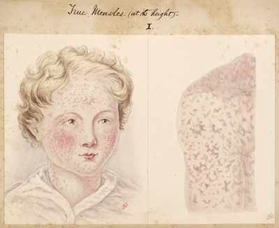 Lot 355 - Measles Manuscript. Essay on Measles, German Measles, and their counterfeits, c. 1883